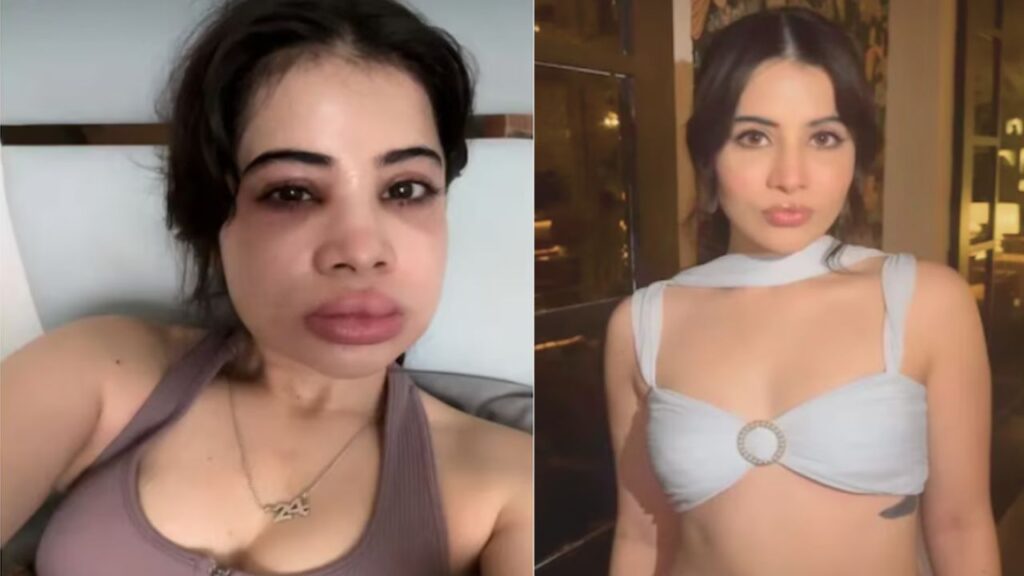 Urfi Javed Gets Lip Fillers Dissolved After 9 Years