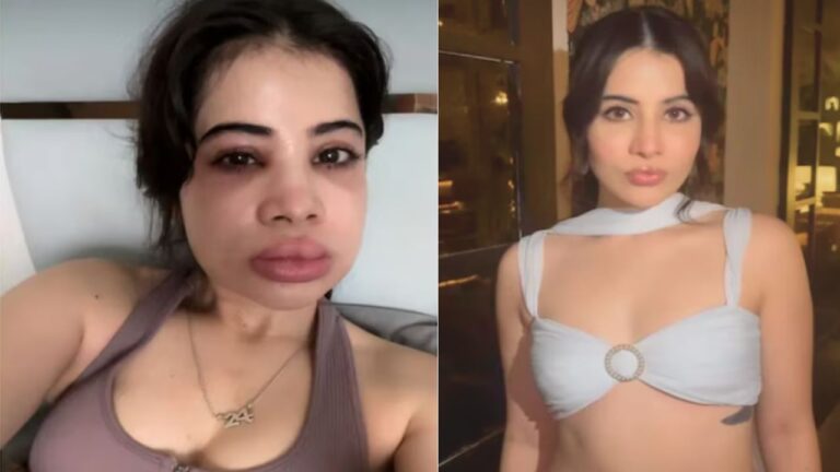 Urfi Javed Gets Lip Fillers Dissolved After 9 Years