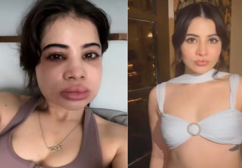 Urfi Javed Gets Lip Fillers Dissolved After 9 Years